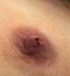 Spontaneous nipple discharge