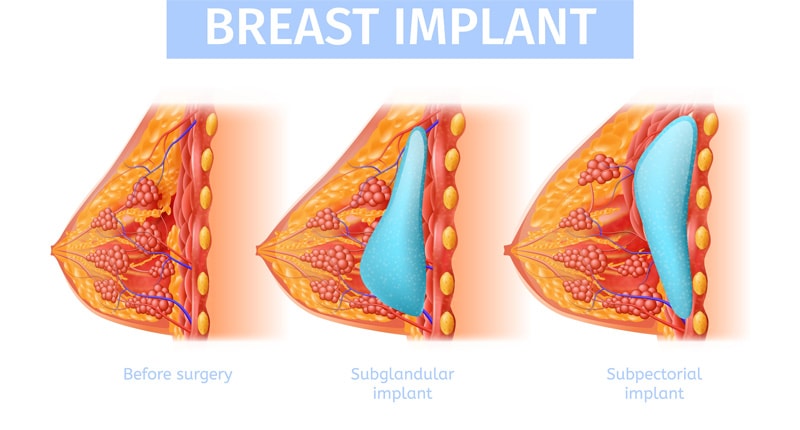 Implants and breast cancer