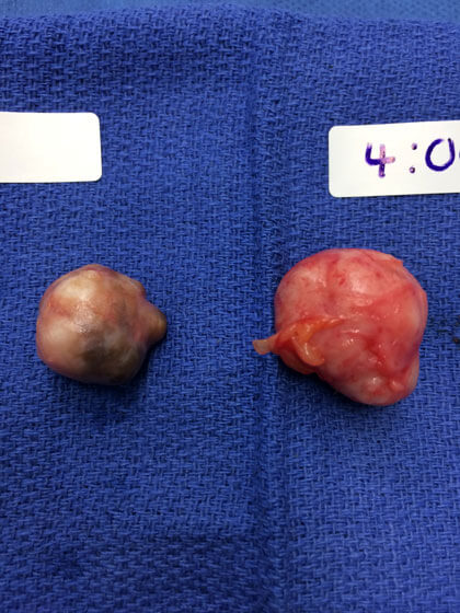 Two fibroadenomas from the same patient